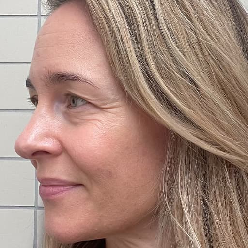 Before photo of woman having taken The Solution, Oslo Skin Lab's collagen powder. Her name is Charlotte.